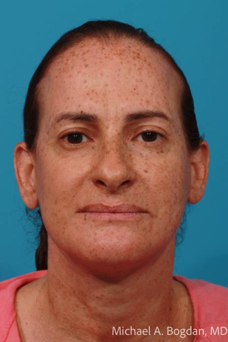 After image 1 Case #111961 - Face lift