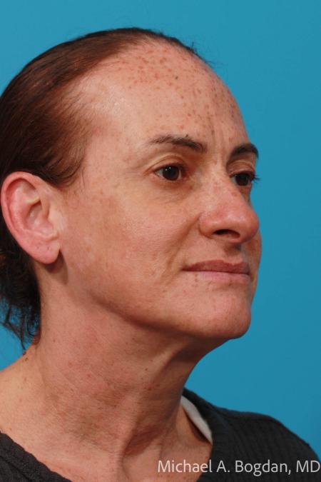 Before image 2 Case #111961 - Face lift