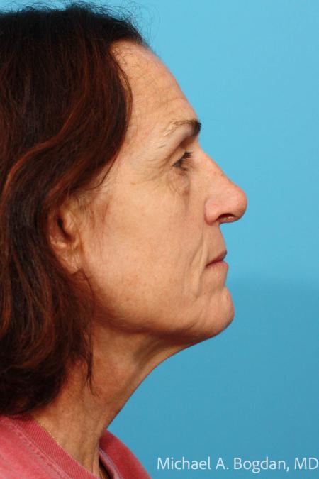 After image 3 Case #112036 - Rhinoplasty