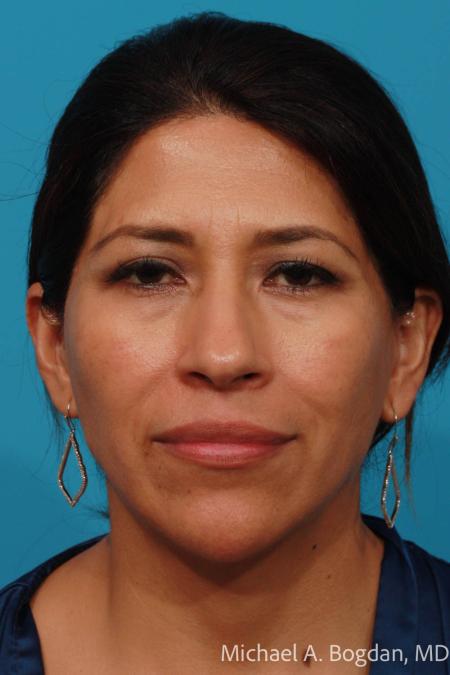 Before image 1 Case #111951 - Blepharoplasty