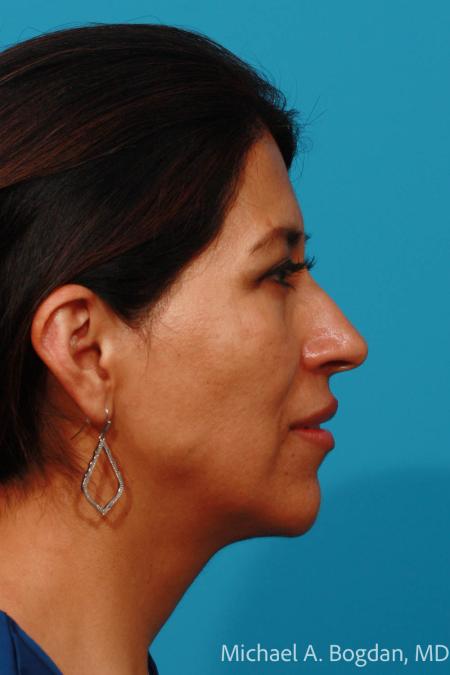 Before image 3 Case #111951 - Blepharoplasty