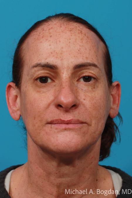 Before image 1 Case #111961 - Face lift