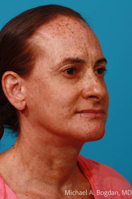 After image 2 Case #111961 - Face lift
