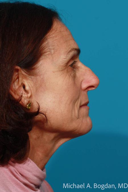 Before image 3 Case #112036 - Rhinoplasty