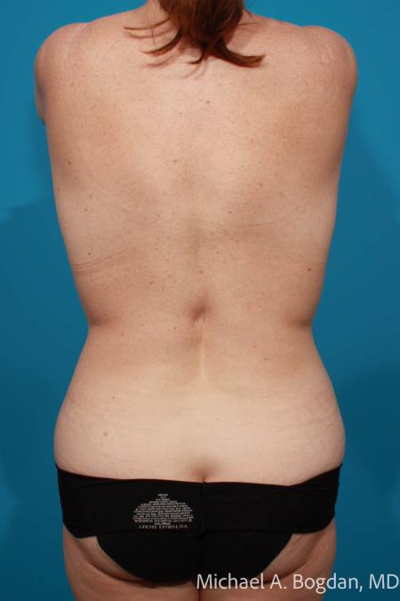 Before image 5 Case #111966 - Mommy Makeover