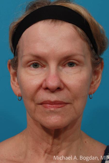 After image 1 Case #112191 - Blepharoplasty