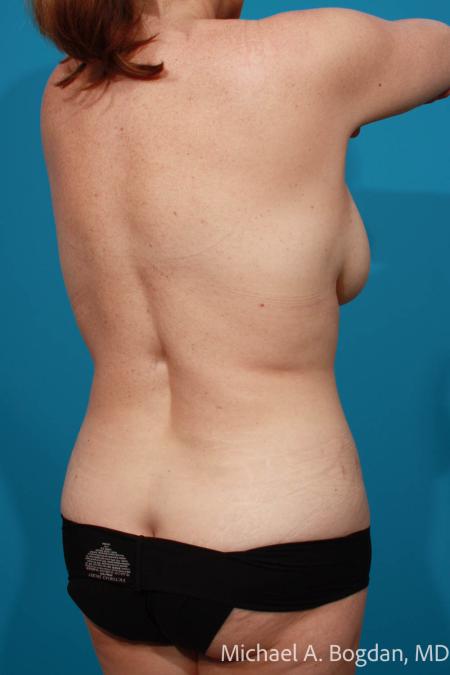 Before image 4 Case #111966 - Mommy Makeover
