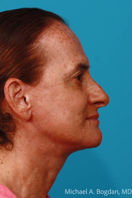 After image 3 Case #111961 - Face lift