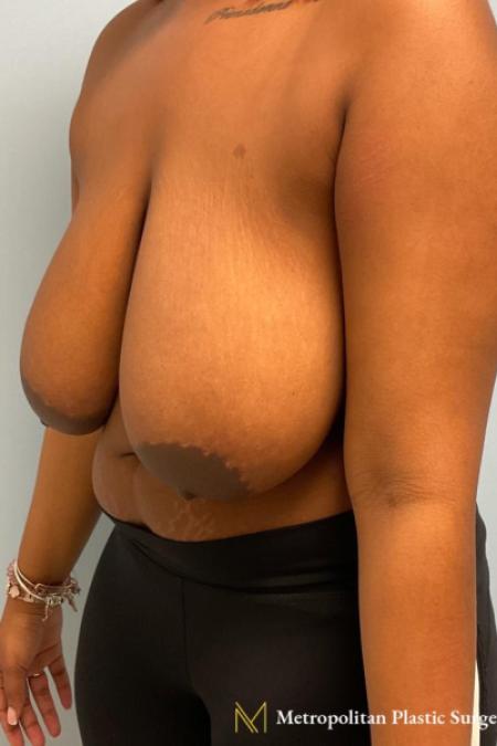 Before image 2 Case #112296 - Breast reduction