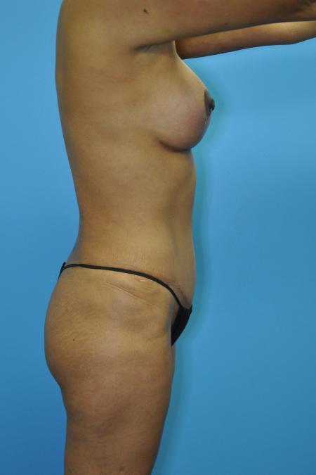 After image 3 Case #112616 - Mommy Makeover transformation