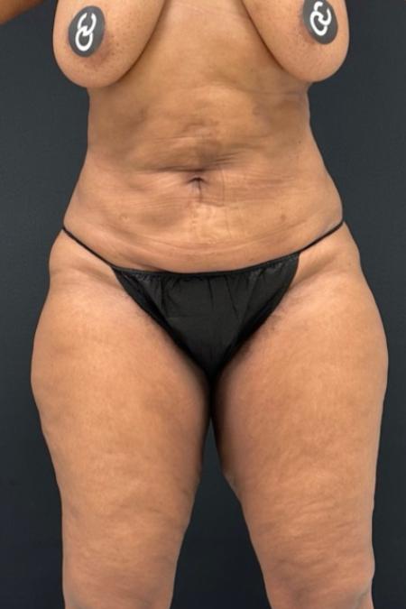Before image 1 Case #112451 - Hi-Definition Abdominoplasty with Renuvion