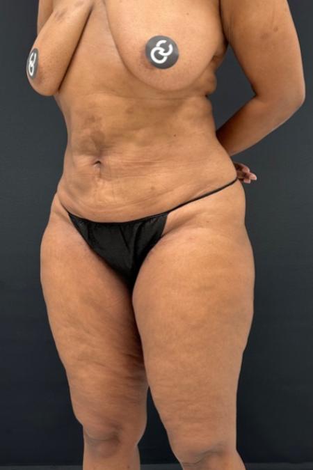 Before image 2 Case #112451 - Hi-Definition Abdominoplasty with Renuvion