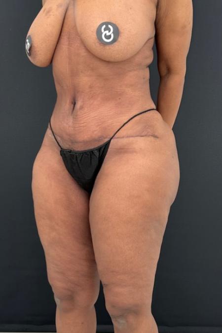 After image 2 Case #112451 - Hi-Definition Abdominoplasty with Renuvion