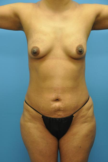 Before image 1 Case #112616 - Mommy Makeover transformation