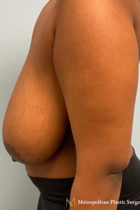 Before image 3 Case #112296 - Breast reduction