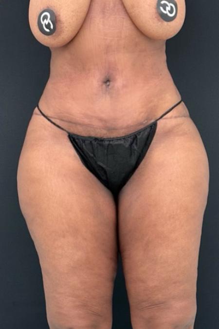 After image 1 Case #112451 - Hi-Definition Abdominoplasty with Renuvion