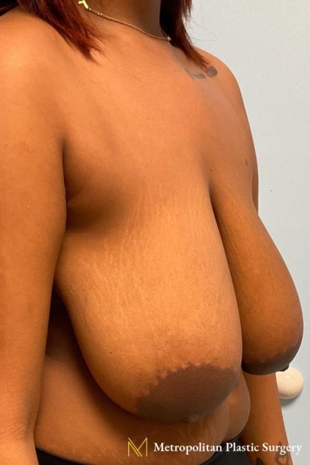 Before image 4 Case #112296 - Breast reduction