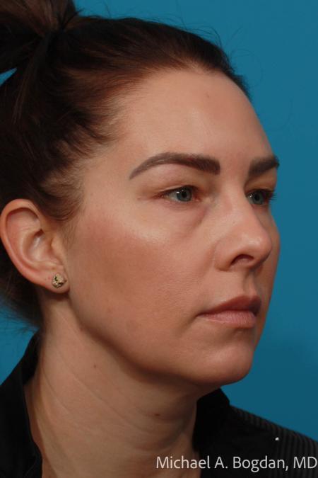 Before image 2 Case #115336 - Upper and Lower Lid Blepharoplasty