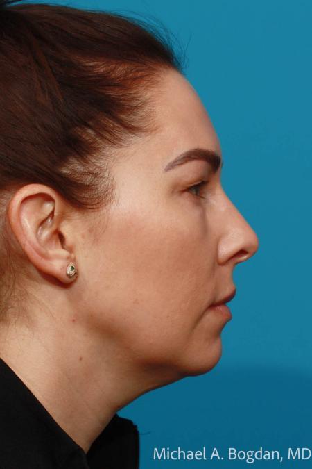 Before image 3 Case #115336 - Upper and Lower Lid Blepharoplasty