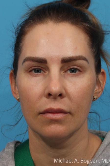 After image 1 Case #115336 - Upper and Lower Lid Blepharoplasty