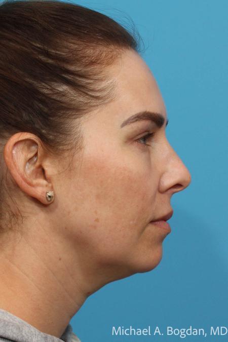 After image 3 Case #115336 - Upper and Lower Lid Blepharoplasty