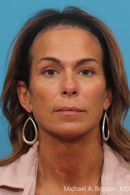 After image 1 Case #115376 - Brow Lift and Blepharoplasty