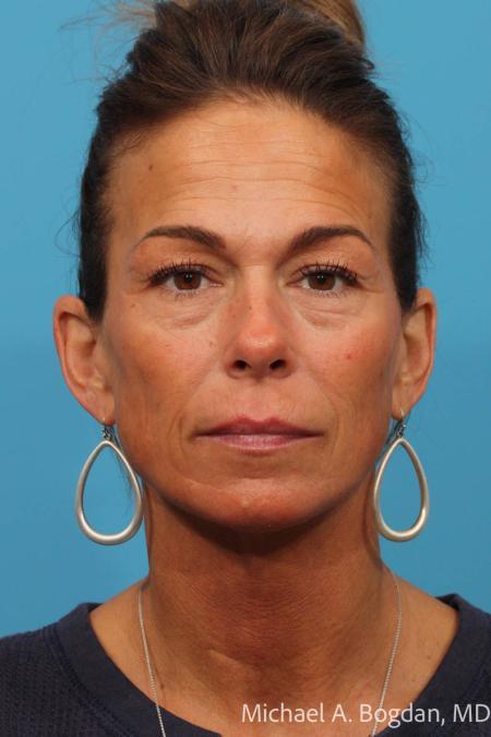 Before image 1 Case #115376 - Brow Lift and Blepharoplasty