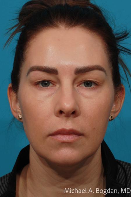 Before image 1 Case #115336 - Upper and Lower Lid Blepharoplasty