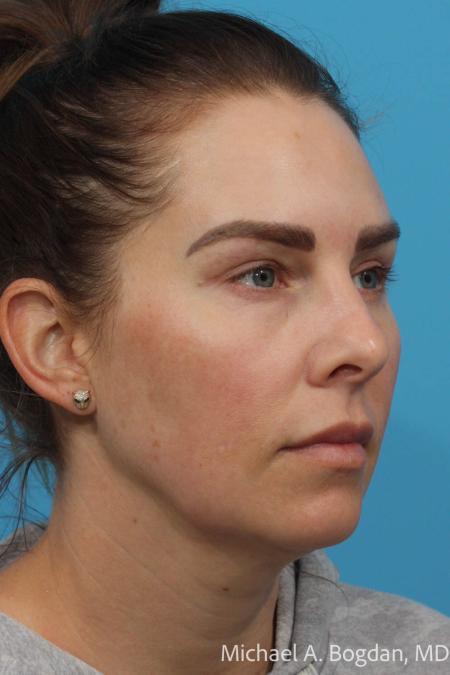 After image 2 Case #115336 - Upper and Lower Lid Blepharoplasty