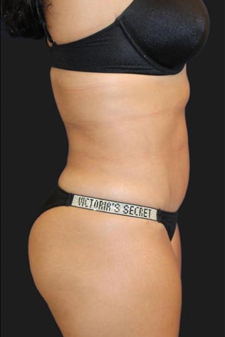 After image 3 Case #116271 - 39 year old patient | Tummy Tuck