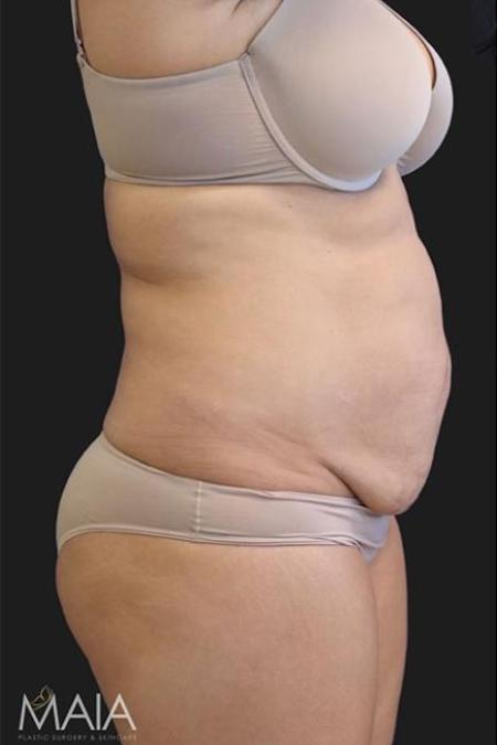 Before image 3 Case #116271 - 39 year old patient | Tummy Tuck