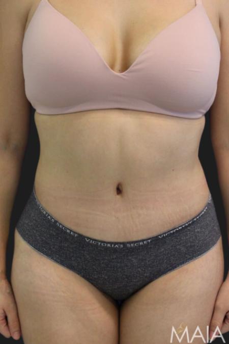 After Case #116451 - 33 year-old patient | Tummy Tuck