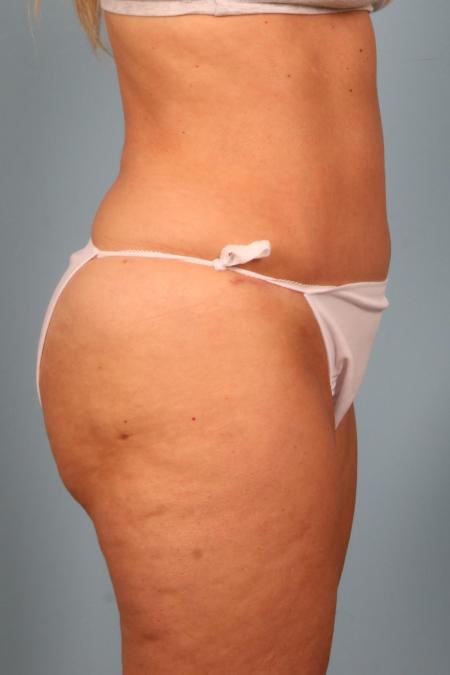 After image 3 Case #116471 - Abdominoplasty and Thigh Liposuction
