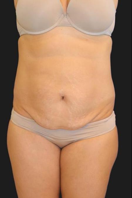 Before image 1 Case #116271 - 39 year old patient | Tummy Tuck
