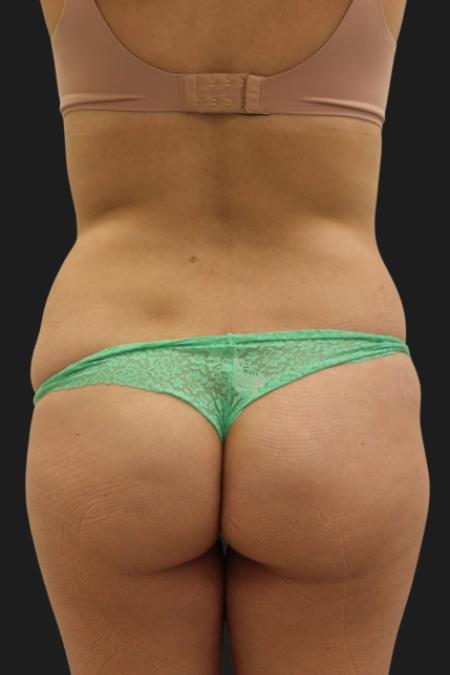Before Case #116451 - 33 year-old patient | Tummy Tuck