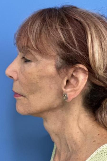 After image 3 Case #116231 - 72 year old  -  Facelift  - 3 month post-op