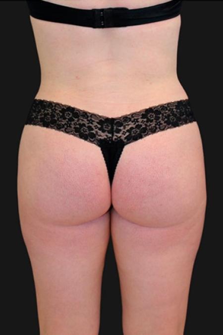 After Case #116306 - 32 year old patient | Tummy Tuck