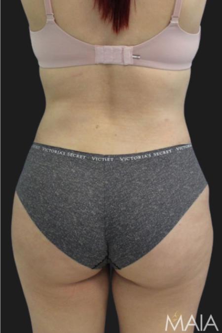 After Case #116451 - 33 year-old patient | Tummy Tuck