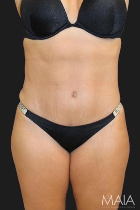 After image 1 Case #116271 - 39 year old patient | Tummy Tuck