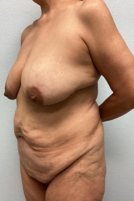 Before image 2 Case #116106 - Massive Weight Loss Mommy Makeover