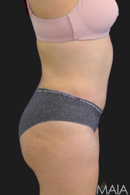 After Case #116451 - 33 year-old patient | Tummy Tuck