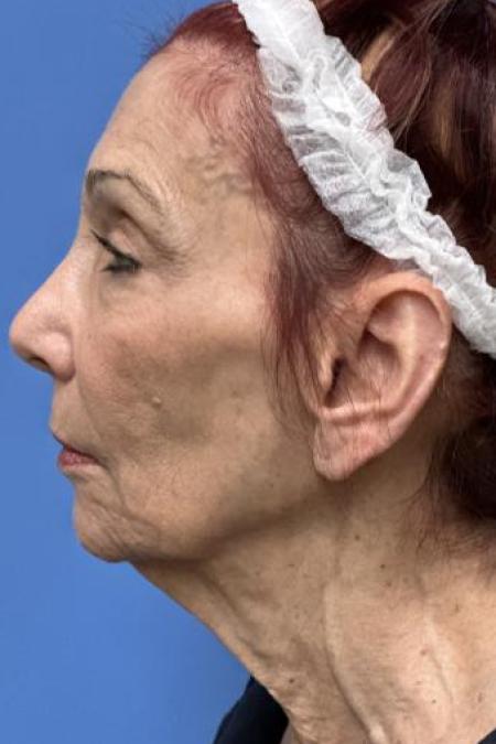 Before image 3 Case #116231 - 72 year old  -  Facelift  - 3 month post-op