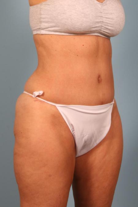 After image 2 Case #116471 - Abdominoplasty and Thigh Liposuction