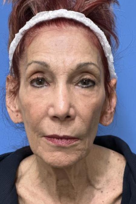 Before image 1 Case #116231 - 72 year old  -  Facelift  - 3 month post-op