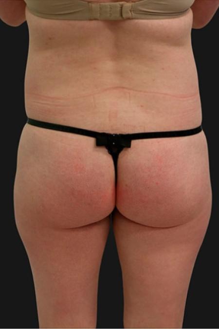 Before Case #116306 - 32 year old patient | Tummy Tuck