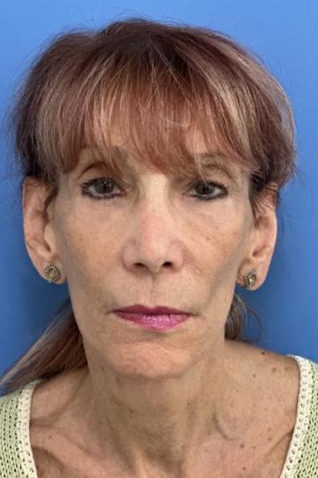 After image 1 Case #116231 - 72 year old  -  Facelift  - 3 month post-op