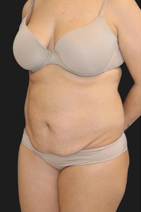 Before image 2 Case #116271 - 39 year old patient | Tummy Tuck