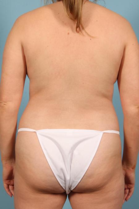 Before image 4 Case #116546 - Mommy Makeover