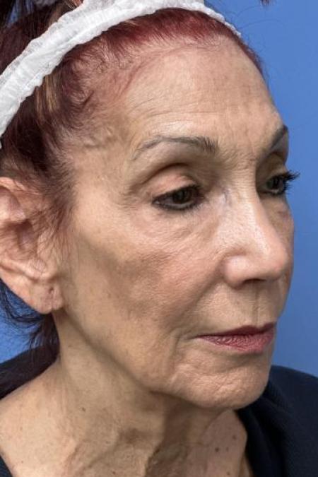 Before image 2 Case #116231 - 72 year old  -  Facelift  - 3 month post-op