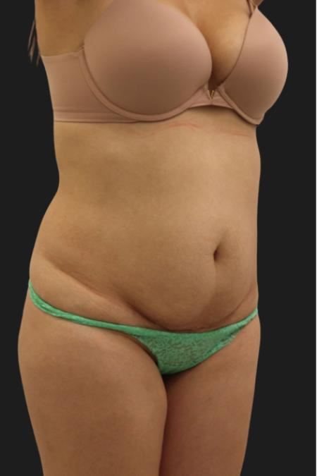 Before Case #116451 - 33 year-old patient | Tummy Tuck